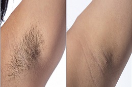 Best Laser Hair Removal Cost in Dubai