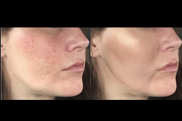 Best Laser Treatment For Acne Scars Cost Clinic in Dubai
