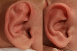 Best Preauricular Tag Removal Clinic in Dubai