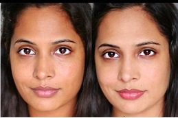 Best Skin Whitening Treatment Cost Clinic in Dubai