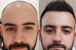Best Turkish Hair Transplant in Dubai