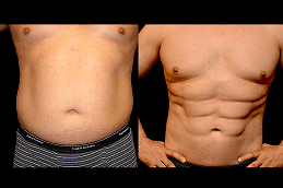 Best six pack abs surgery Clinic in Dubai