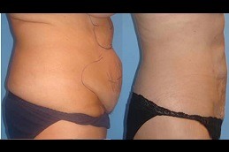 Bodytite Liposuction in Dubai