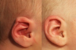 Buccal Preauricular Tag Removal Clinic in Abu Dhabi