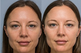 Face Filler Injections Cost in Dubai