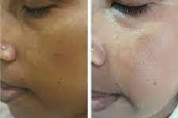 Side Effects of Glutathione Skin Whitening Injections in Dubai