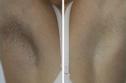 The Ordinary Peeling Solution for Underarms in Dubai