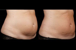 how to lose belly fat Clinic in Dubai & Abu Dhabi