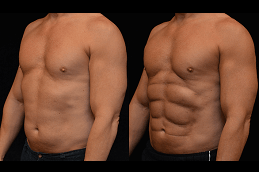 six pack abs surgery in Dubai