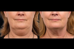 Best Double Chin Removal Non-Surgical Clinic in Dubai