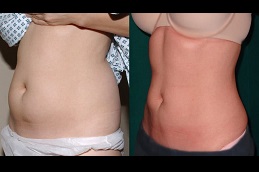 Best How Long is Recovery from 360 Liposuction Clinic in Dubai