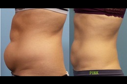 Best How Long is Recovery from 360 Liposuction in Dubai