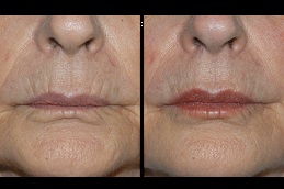 Best Laser Treatment for Dark Lips Clinic in Dubai