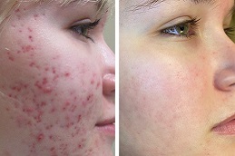 Best Microneedling for Acne Scars Cost Clinic in Dubai