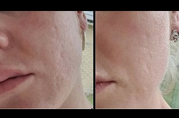 Best Microneedling for Acne Scars Cost in Dubai