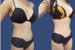 Best What is the Difference Between Lipo and Lipo 360 in Dubai