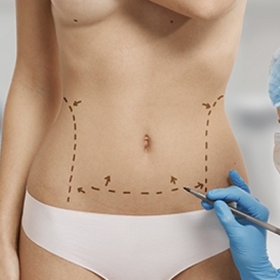 How Long is Recovery from 360 Liposuction in Dubai & Abu Dhabi Cost