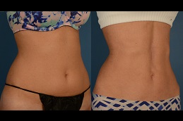 How Long is Recovery from 360 Liposuction in Dubai