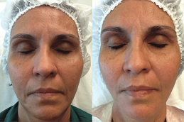Hyaluronic Acid Injections for Face in Dubai