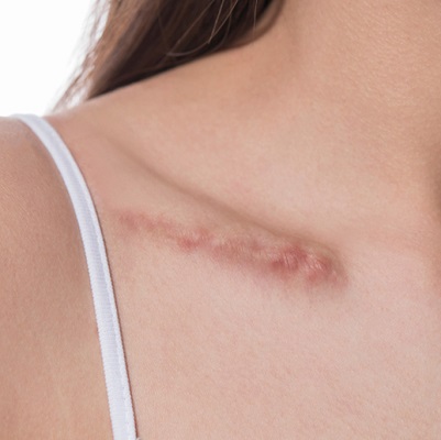 Hypertrophic Scars Removal Treatment in Dubai, Abu Dhabi & Sharjah