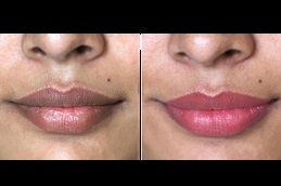 Laser Treatment for Dark Lips in Dubai