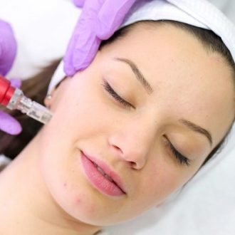 Microneedling for Acne Scars Cost in Dubai