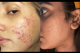 Microneedling for Acne Scars Cost in Dubai