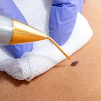 How To Get Rid of Genital Warts in Dubai?