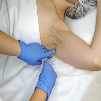 Botox for Underarm Sweating in Dubai: Safe & Effective