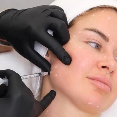 Masseter Botox Injection Treatment Dubai