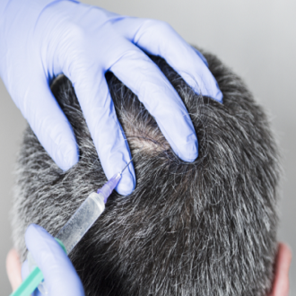 PRP Treatment For White Hair in Dubai