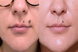 laser mole removal in dubai