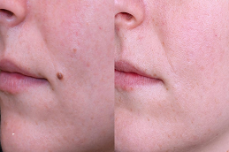 mole removal in abu dhabi