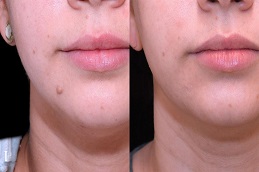 mole removal in dubai