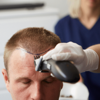 Biofibre Hair Implant Cost in Dubai