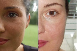 Best Microneedling Treatment in Dubai