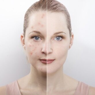 How to Get Rid of Back Acne Scars