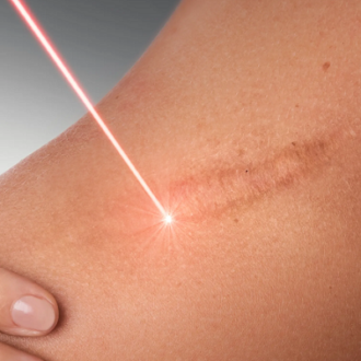 Laser Scar Removal Cost in Dubai