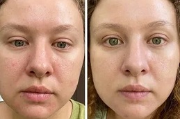 Microneedling Treatment dubai