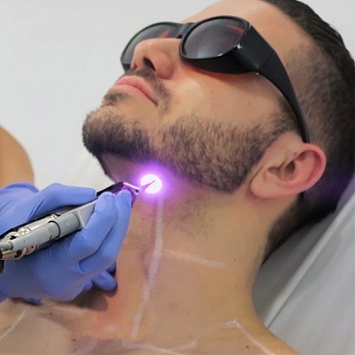Beard Laser Hair Removal in Dubai & Abu Dhabi