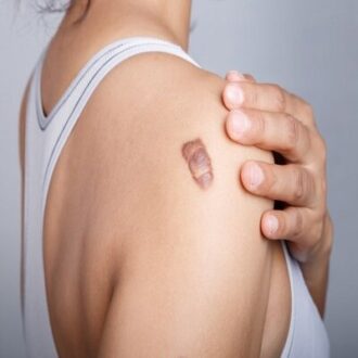 Lipoma Treatment Cost in Dubai & Abu Dhabi