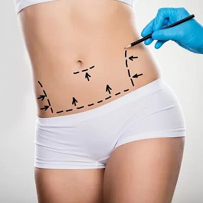 Tummy Tuck in Dubai