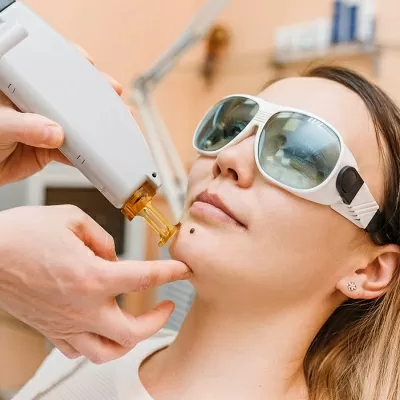 Facial Mole Removal in Dubai: What Works and What’s Safe