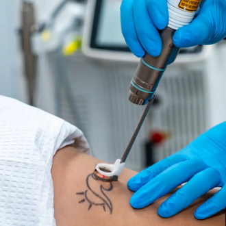 Laser Tattoo Removal Cost in Dubai